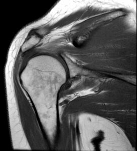 MRI of upper extremity