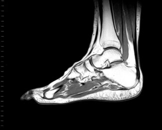 Foot MRI lower extremity