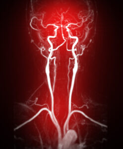 Cardiac MRI of arteries