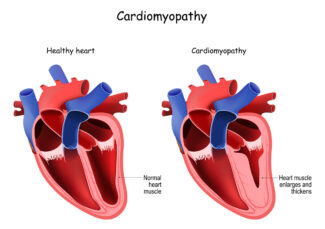 cardiac mri heart disease