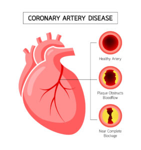 cardiac mri heart disease