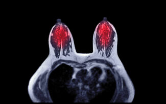 Breast MRI