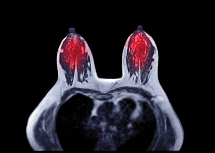 Breast MRI