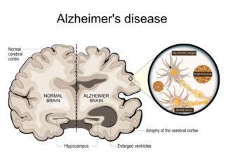 MRI for Alzheimers