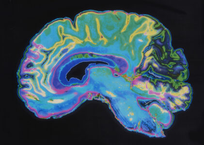 Using MRI to Diagnose and Monitor Alzheimer’s Disease and Dementia