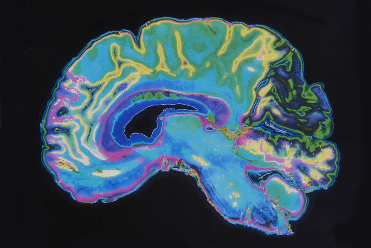 Using MRI to Diagnose and Monitor Alzheimer’s Disease and Dementia