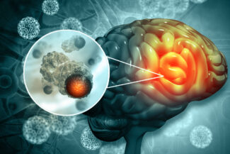 brain cancer
