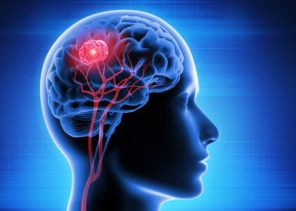Brain Cancer