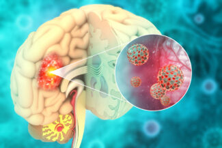 brain cancer MRI