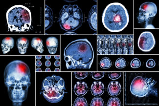 brain cancer advanced MRI