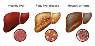 Liver MRI