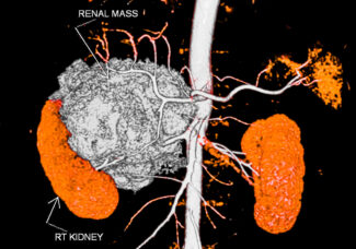 MRI for renal mass - kidney MRI