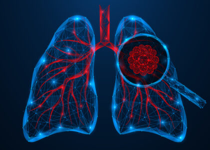Lung Cancer Awareness Month: Early Detection, Evolving Risks, and the Importance of Screening