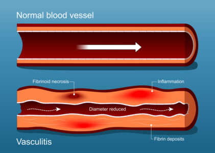 Malformations of the Blood Vessels and Vasculitis