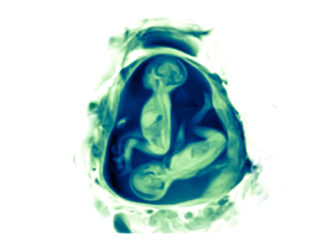 MRI pregnant twins