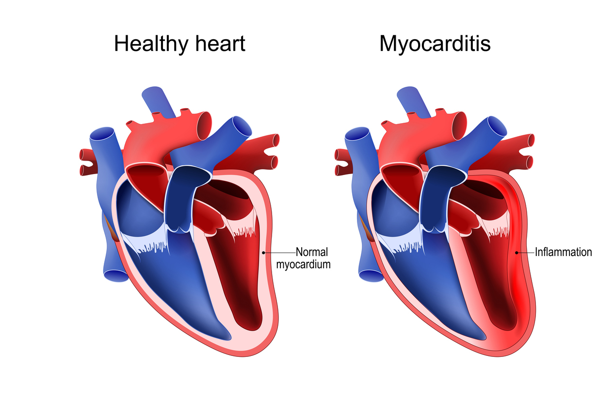 Myocarditis and Pericarditis - Greater Waterbury Imaging Center