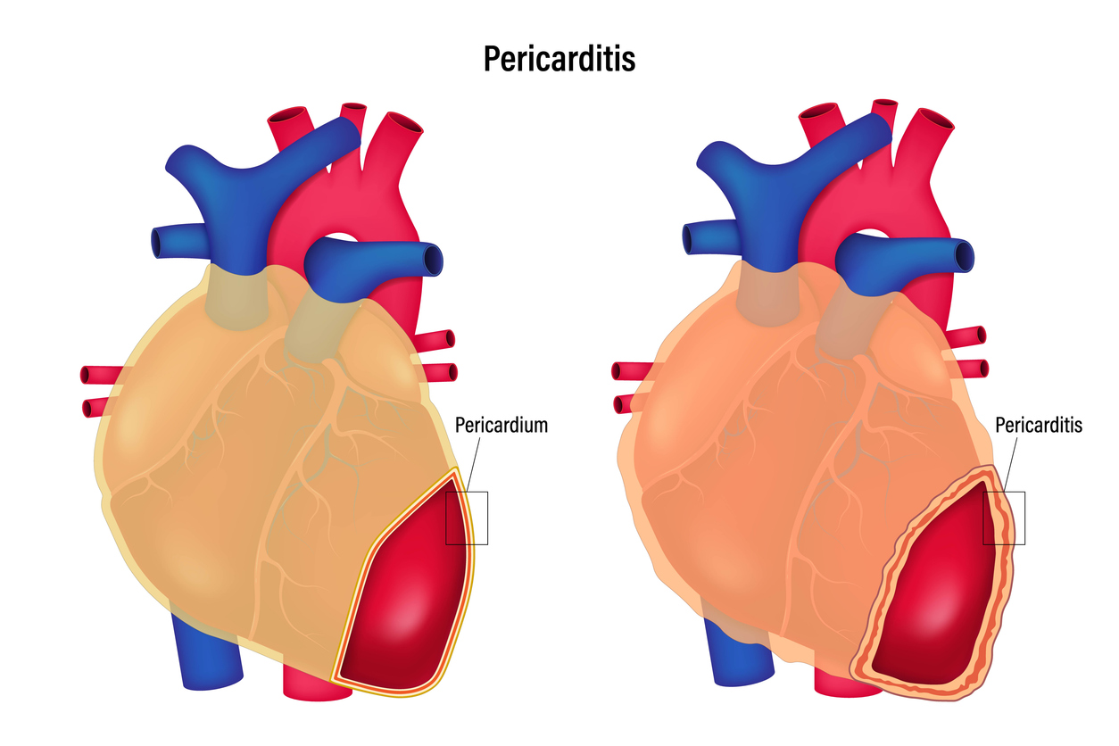 Myocarditis and Pericarditis - Greater Waterbury Imaging Center