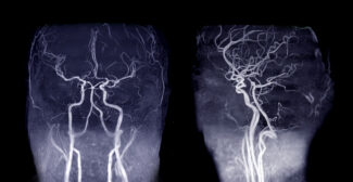 MRA of the Carotid Arteries