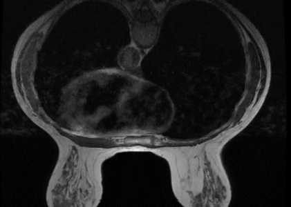 MR BILATERAL BREASTS WITH AND WITHOUT IV CONTRAST