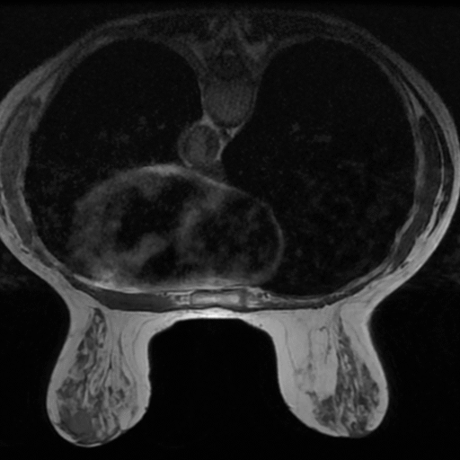 MR BILATERAL BREASTS WITH AND WITHOUT IV CONTRAST