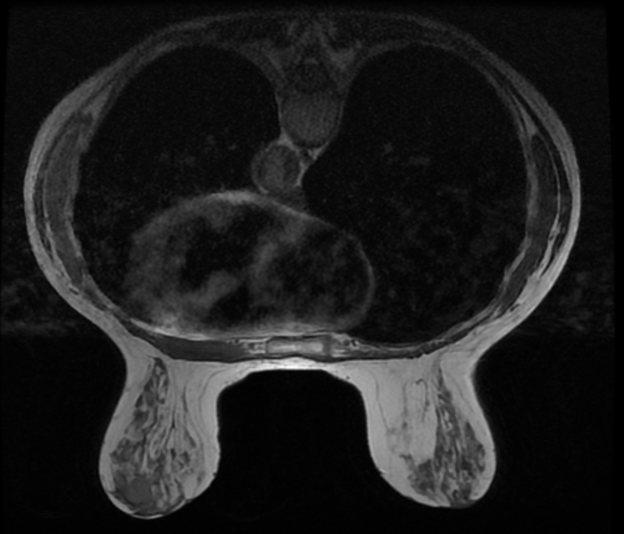 Breast imaging Axial T1 FSE